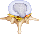 Illustration of compressed nerve pain